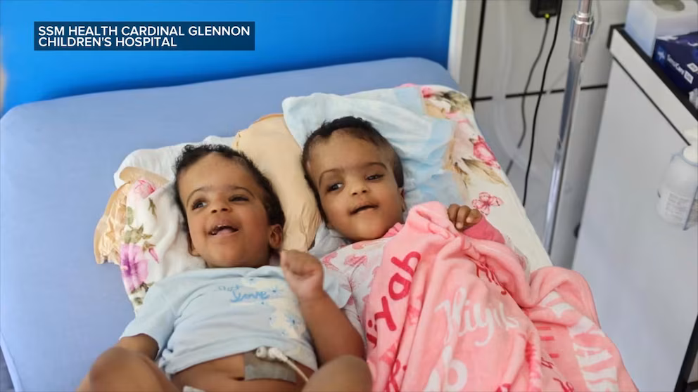WATCH:  Conjoined twins start new chapter after profitable separation